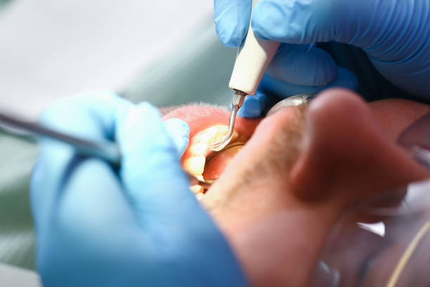 Best Emergency Dentist for Lost Fillings or Crowns in Rosemead, CA