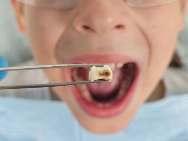 Best Emergency Dentist for Lost Fillings or Crowns in Rosemead, CA